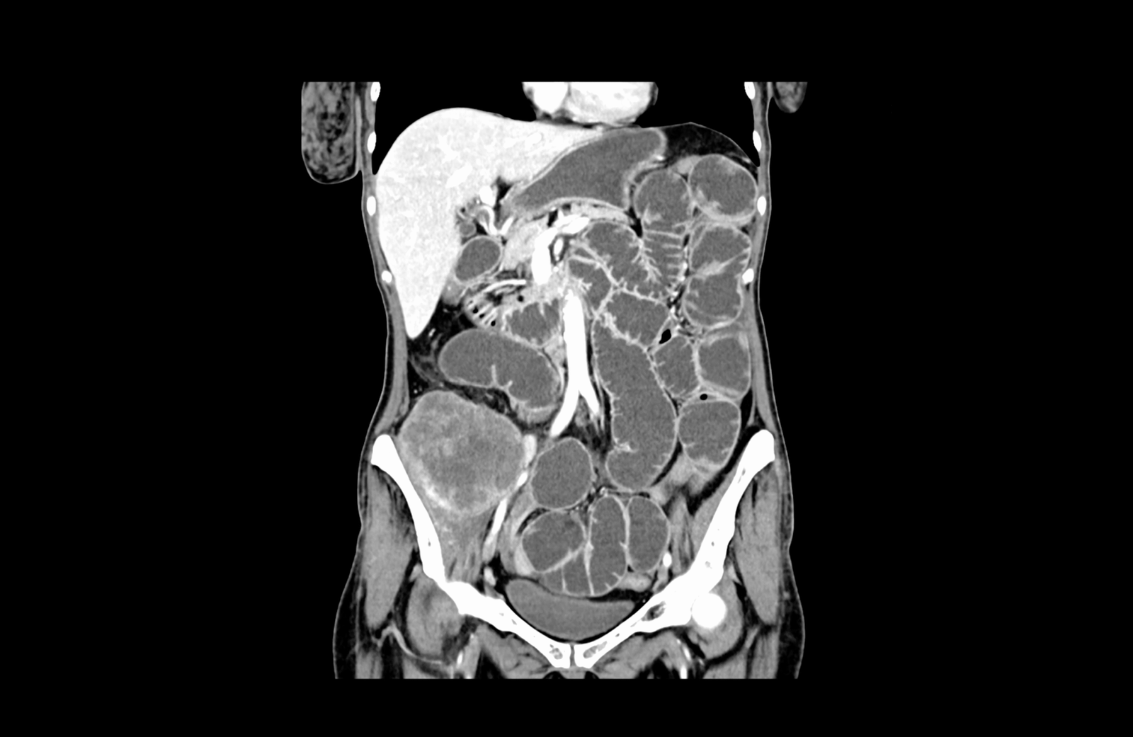 mechanic ileum in advance colorectal cancer of the right colon