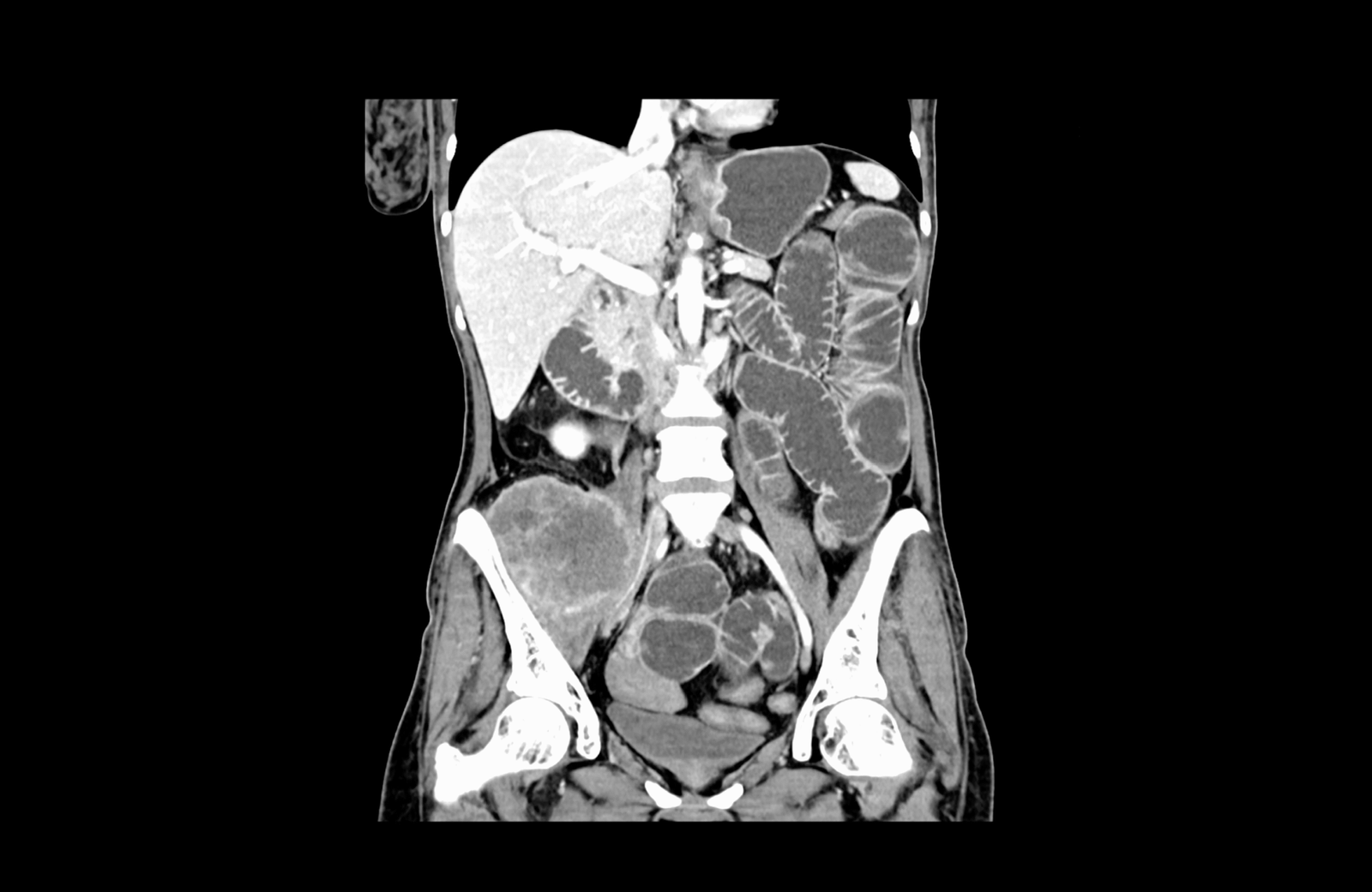 colon cancer and mechanic ileum