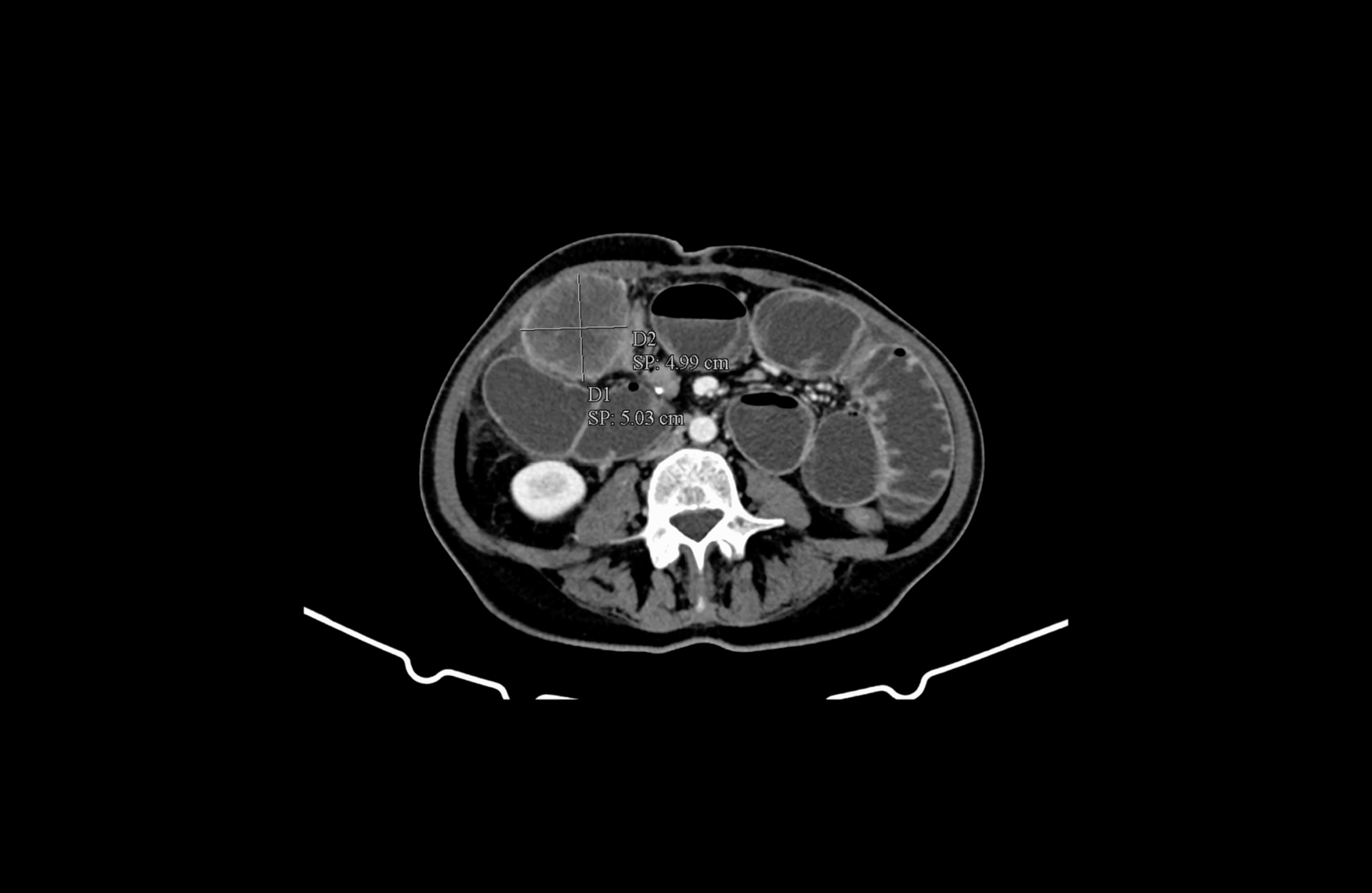 infiltration of anterior abdominal wall by advanced colon cancer