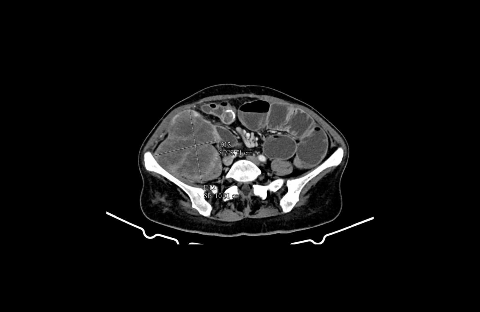 infiltration of iliopsoas muscle, femoral nerve, compression of the iliac vessels
