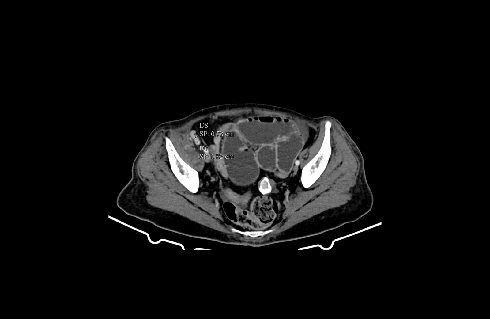 parailiac metastatic lymphadenomegaly