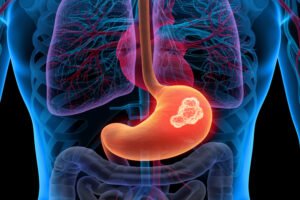 рак на стомаха